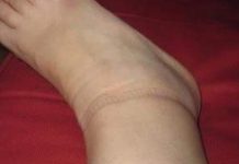 KAD SKINETE ČARAPE OSTANU VAM TRAGOVI NA NOGAMA: Evo šta se dešava sa vašim zdravljem KAD SKINETE ČARAPE OSTANU VAM TRAGOVI NA NOGAMA: Evo šta se dešava sa vašim zdravljem - featured image