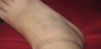 KAD SKINETE ČARAPE OSTANU VAM TRAGOVI NA NOGAMA: Evo šta se dešava sa vašim zdravljem KAD SKINETE ČARAPE OSTANU VAM TRAGOVI NA NOGAMA: Evo šta se dešava sa vašim zdravljem - featured image