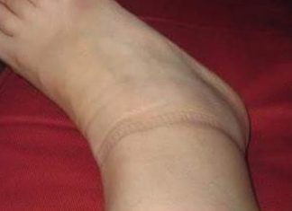 KAD SKINETE ČARAPE OSTANU VAM TRAGOVI NA NOGAMA: Evo šta se dešava sa vašim zdravljem KAD SKINETE ČARAPE OSTANU VAM TRAGOVI NA NOGAMA: Evo šta se dešava sa vašim zdravljem - featured image