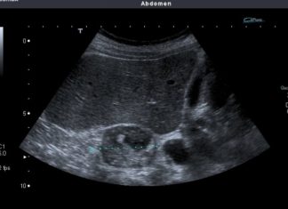 NADBUBREŽNA ŽLIJEZDA MOŽE DA RAZORI CIJELI ORGANIZAM: Simptomi koje nikako ne smijete da ignorišete! NADBUBREŽNA ŽLIJEZDA MOŽE DA RAZORI CIJELI ORGANIZAM: Simptomi koje nikako ne smijete da ignorišete! - featured image