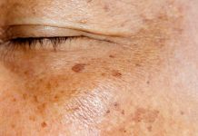 ZNATE LI ŠTA SU USTVARI STARAČKE PJEGE? Dermatolog objasnio kako nastaju smeđe mrlje na licu, A EVO KAKO DA IH SE ZAUVIJEK RIJEŠITE ZNATE LI ŠTA SU USTVARI STARAČKE PJEGE? Dermatolog objasnio kako nastaju smeđe mrlje na licu, A EVO KAKO DA IH SE ZAUVIJEK RIJEŠITE - featured image