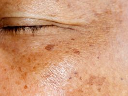 ZNATE LI ŠTA SU USTVARI STARAČKE PJEGE? Dermatolog objasnio kako nastaju smeđe mrlje na licu, A EVO KAKO DA IH SE ZAUVIJEK RIJEŠITE ZNATE LI ŠTA SU USTVARI STARAČKE PJEGE? Dermatolog objasnio kako nastaju smeđe mrlje na licu, A EVO KAKO DA IH SE ZAUVIJEK RIJEŠITE - featured image
