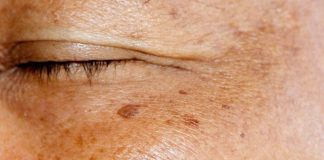 ZNATE LI ŠTA SU USTVARI STARAČKE PJEGE? Dermatolog objasnio kako nastaju smeđe mrlje na licu, A EVO KAKO DA IH SE ZAUVIJEK RIJEŠITE ZNATE LI ŠTA SU USTVARI STARAČKE PJEGE? Dermatolog objasnio kako nastaju smeđe mrlje na licu, A EVO KAKO DA IH SE ZAUVIJEK RIJEŠITE - featured image