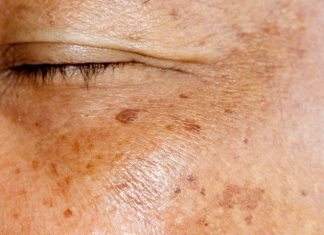 ZNATE LI ŠTA SU USTVARI STARAČKE PJEGE? Dermatolog objasnio kako nastaju smeđe mrlje na licu, A EVO KAKO DA IH SE ZAUVIJEK RIJEŠITE ZNATE LI ŠTA SU USTVARI STARAČKE PJEGE? Dermatolog objasnio kako nastaju smeđe mrlje na licu, A EVO KAKO DA IH SE ZAUVIJEK RIJEŠITE - featured image