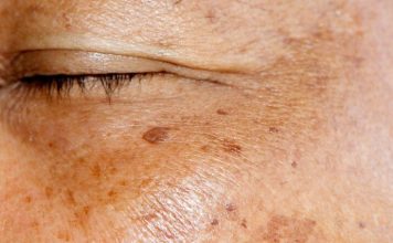 ZNATE LI ŠTA SU USTVARI STARAČKE PJEGE? Dermatolog objasnio kako nastaju smeđe mrlje na licu, A EVO KAKO DA IH SE ZAUVIJEK RIJEŠITE ZNATE LI ŠTA SU USTVARI STARAČKE PJEGE? Dermatolog objasnio kako nastaju smeđe mrlje na licu, A EVO KAKO DA IH SE ZAUVIJEK RIJEŠITE - featured image