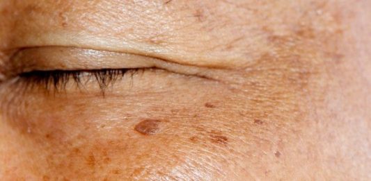 ZNATE LI ŠTA SU USTVARI STARAČKE PJEGE? Dermatolog objasnio kako nastaju smeđe mrlje na licu, A EVO KAKO DA IH SE ZAUVIJEK RIJEŠITE ZNATE LI ŠTA SU USTVARI STARAČKE PJEGE? Dermatolog objasnio kako nastaju smeđe mrlje na licu, A EVO KAKO DA IH SE ZAUVIJEK RIJEŠITE - featured image