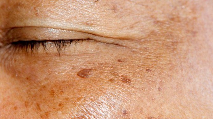 ZNATE LI ŠTA SU USTVARI STARAČKE PJEGE? Dermatolog objasnio kako nastaju smeđe mrlje na licu, A EVO KAKO DA IH SE ZAUVIJEK RIJEŠITE ZNATE LI ŠTA SU USTVARI STARAČKE PJEGE? Dermatolog objasnio kako nastaju smeđe mrlje na licu, A EVO KAKO DA IH SE ZAUVIJEK RIJEŠITE - featured image