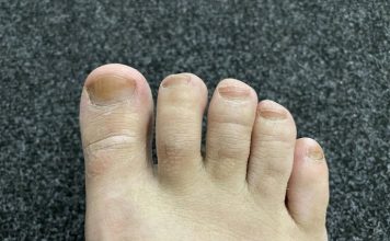IMATE LI GLJIVICE I ŽUTE, ZADEBLJALE NOKTE: Samo namažite ovo ulje i riješit ćete problem preko noći IMATE LI GLJIVICE I ŽUTE, ZADEBLJALE NOKTE: Samo namažite ovo ulje i riješit ćete problem preko noći - featured image