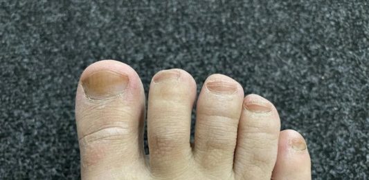 IMATE LI GLJIVICE I ŽUTE, ZADEBLJALE NOKTE: Samo namažite ovo ulje i riješit ćete problem preko noći IMATE LI GLJIVICE I ŽUTE, ZADEBLJALE NOKTE: Samo namažite ovo ulje i riješit ćete problem preko noći - featured image