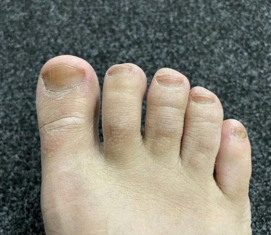 IMATE LI GLJIVICE I ŽUTE, ZADEBLJALE NOKTE: Samo namažite ovo ulje i riješit ćete problem preko noći IMATE LI GLJIVICE I ŽUTE, ZADEBLJALE NOKTE: Samo namažite ovo ulje i riješit ćete problem preko noći - featured image