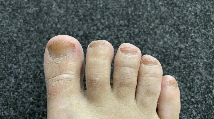 IMATE LI GLJIVICE I ŽUTE, ZADEBLJALE NOKTE: Samo namažite ovo ulje i riješit ćete problem preko noći IMATE LI GLJIVICE I ŽUTE, ZADEBLJALE NOKTE: Samo namažite ovo ulje i riješit ćete problem preko noći - featured image