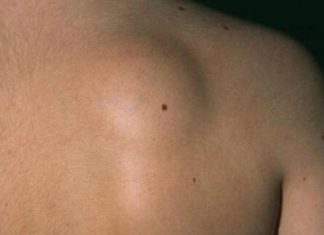 ZA MANJE OD 10 DANA: Riješite se masnog tkiva bez hiruškog odstranjivanja! ZA MANJE OD 10 DANA: Riješite se masnog tkiva bez hiruškog odstranjivanja! - featured image