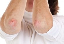 Nikad više nećete baciti KORU OVE VOĆKE: Liječi psorijazu, skida bradavice i izbjeljuje zube! Nikad više nećete baciti KORU OVE VOĆKE: Liječi psorijazu, skida bradavice i izbjeljuje zube! - featured image