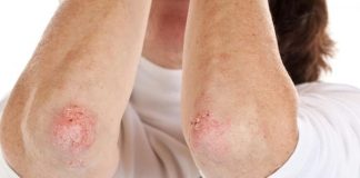 Nikad više nećete baciti KORU OVE VOĆKE: Liječi psorijazu, skida bradavice i izbjeljuje zube! Nikad više nećete baciti KORU OVE VOĆKE: Liječi psorijazu, skida bradavice i izbjeljuje zube! - featured image