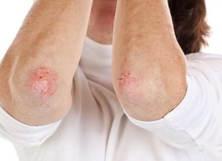 Nikad više nećete baciti KORU OVE VOĆKE: Liječi psorijazu, skida bradavice i izbjeljuje zube! Nikad više nećete baciti KORU OVE VOĆKE: Liječi psorijazu, skida bradavice i izbjeljuje zube! - featured image
