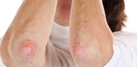 Nikad više nećete baciti KORU OVE VOĆKE: Liječi psorijazu, skida bradavice i izbjeljuje zube! Nikad više nećete baciti KORU OVE VOĆKE: Liječi psorijazu, skida bradavice i izbjeljuje zube! - featured image
