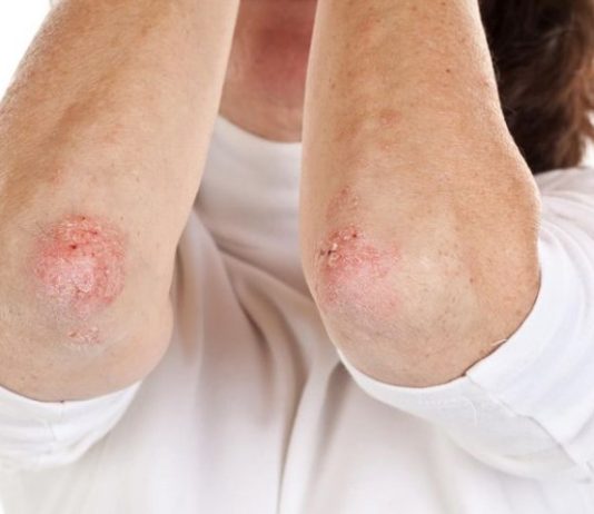 Nikad više nećete baciti KORU OVE VOĆKE: Liječi psorijazu, skida bradavice i izbjeljuje zube! Nikad više nećete baciti KORU OVE VOĆKE: Liječi psorijazu, skida bradavice i izbjeljuje zube! - featured image