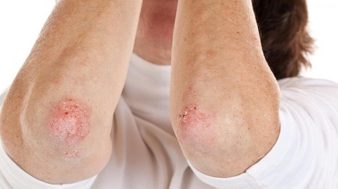 Nikad više nećete baciti KORU OVE VOĆKE: Liječi psorijazu, skida bradavice i izbjeljuje zube! Nikad više nećete baciti KORU OVE VOĆKE: Liječi psorijazu, skida bradavice i izbjeljuje zube! - featured image
