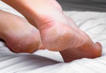 Domaći melem za grube i ispucale pete bake su znale napamet: Koriste se 2 prirodna sastojka Domaći melem za grube i ispucale pete bake su znale napamet: Koriste se 2 prirodna sastojka - featured image