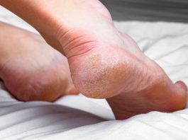 Domaći melem za grube i ispucale pete bake su znale napamet: Koriste se 2 prirodna sastojka Domaći melem za grube i ispucale pete bake su znale napamet: Koriste se 2 prirodna sastojka - featured image