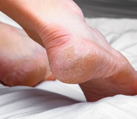 Domaći melem za grube i ispucale pete bake su znale napamet: Koriste se 2 prirodna sastojka Domaći melem za grube i ispucale pete bake su znale napamet: Koriste se 2 prirodna sastojka - featured image