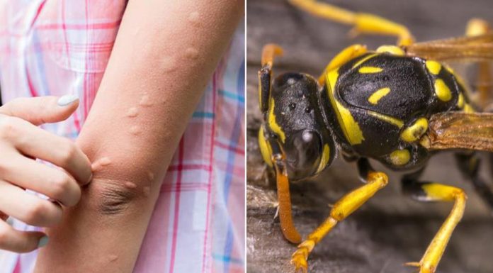 Simptomi ujeda stršljena koji su bili kobni za 38-godišnju ženu iz Vrnjačke Banje: Evo šta prvo morate da uradite da biste sprečili alergijsku reakciju Simptomi ujeda stršljena koji su bili kobni za 38-godišnju ženu iz Vrnjačke Banje: Evo šta prvo morate da uradite da biste sprečili alergijsku reakciju - featured image