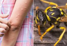 Simptomi ujeda stršljena koji su bili kobni za 38-godišnju ženu iz Vrnjačke Banje: Evo šta prvo morate da uradite da biste sprečili alergijsku reakciju Simptomi ujeda stršljena koji su bili kobni za 38-godišnju ženu iz Vrnjačke Banje: Evo šta prvo morate da uradite da biste sprečili alergijsku reakciju - featured image
