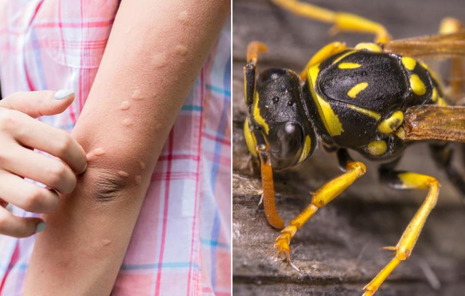 Simptomi ujeda stršljena koji su bili kobni za 38-godišnju ženu iz Vrnjačke Banje: Evo šta prvo morate da uradite da biste sprečili alergijsku reakciju - featured image Simptomi ujeda stršljena koji su bili kobni za 38-godišnju ženu iz Vrnjačke Banje: Evo šta prvo morate da uradite da biste sprečili alergijsku reakciju - featured image