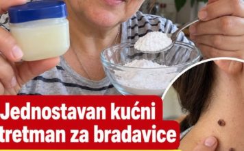 Jednostavan kućni tretman za bradavice. Mnogi ga koriste kao pomoć Jednostavan kućni tretman za bradavice. Mnogi ga koriste kao pomoć - featured image