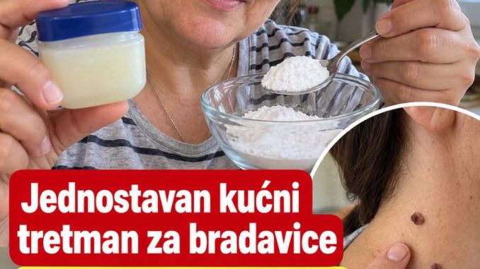 Jednostavan kućni tretman za bradavice. Mnogi ga koriste kao pomoć - featured image Jednostavan kućni tretman za bradavice. Mnogi ga koriste kao pomoć - featured image